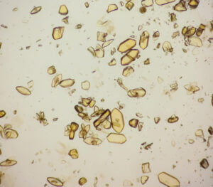 Microscopic image of yellow uric acid crystals, commonly observed in conditions associated with uric acid causes such as gout.