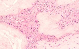 Microscopic image showing uric acid crystal formation within a human joint